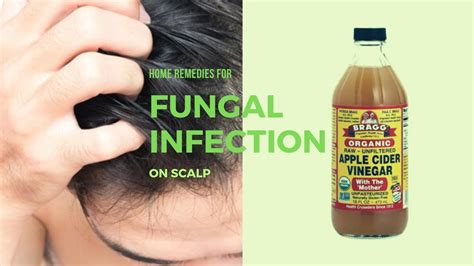 Home Remedies For Fungal Infection On Scalp Youtube