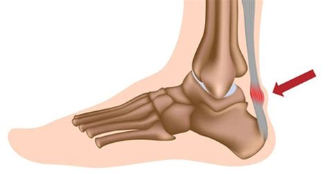 Achilles Tendonitis Diagnosis Treatment And Rehabilitation Exercises