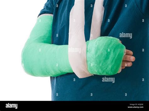 Arm Cast Bright Green Long Arm Cast In A Sling For A Broken Elbow