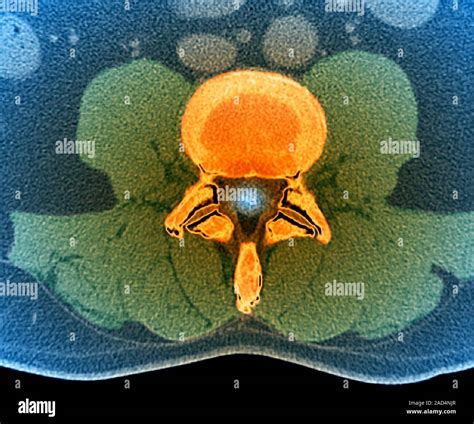 Normal Lumbar Vertebra Coloured Computed Tomography Ct Scan Of An