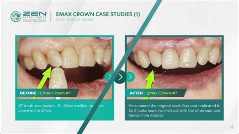 Zen Dental Emax Crown Case Studies 1 Dentist In Seattle