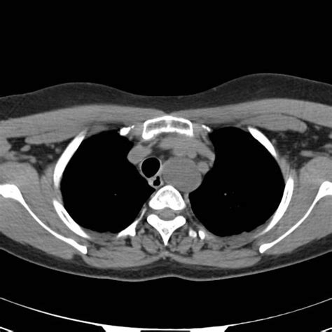 Lymphocoele Of The Thoracic Duct Presenting As A Cystic Lesion On The
