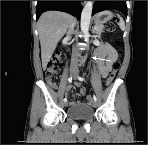 Image Diagnosis Inferior Mesenteric Vein Thrombosis The Permanente