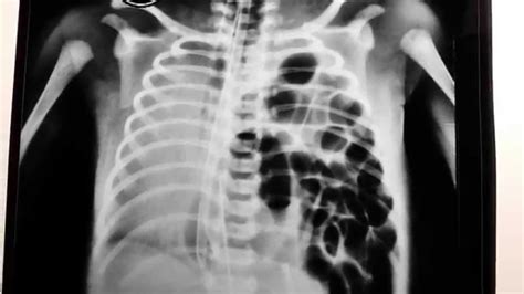 Congenital Diaphragmatic Hernia Chest X Ray Youtube