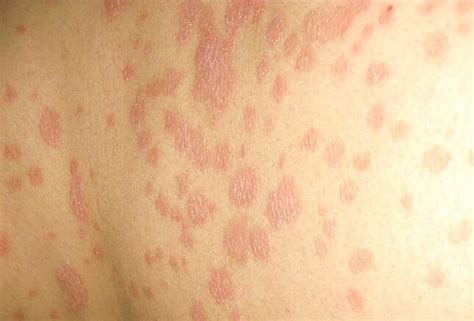 What Is Herpes Simplex 10 Herpesviruses 6 And 7 Treatment For Herpes