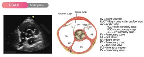 Aortenklappenstenose Ekg And Echo