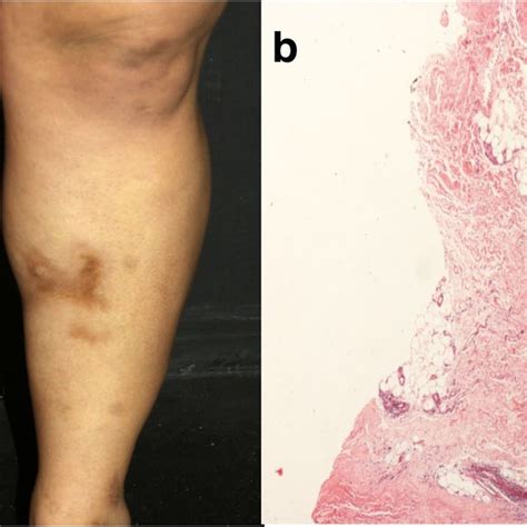 Deep Morphea A Indurated Plaque On The Lower Limb B Thickening Of The