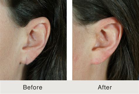 Before And After Earlobe Repair Carolina Facial Plastic Surgery