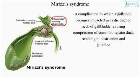 Mirizzi S Syndrome YouTube