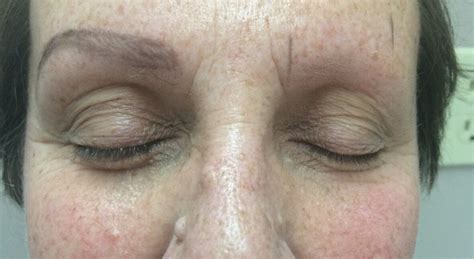 Alison 20 Cancer Survivor Gets Confidence Boost From Eyebrow