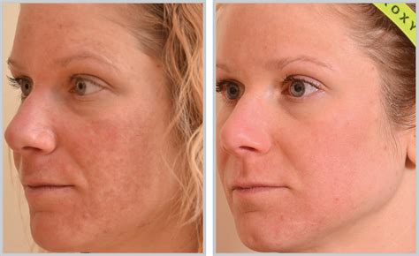 Laser Facial Treatment Before And After Dailymigrants Com