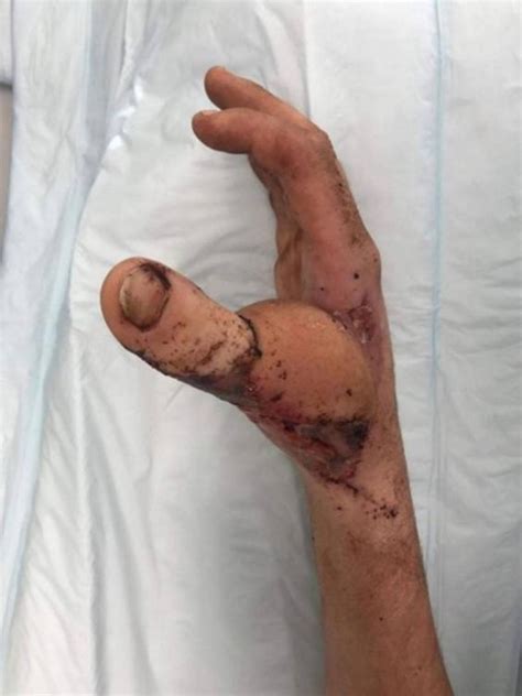 Joven perdió su dedo pulgar en un accidente médicos hallaron