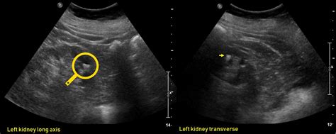 Ultrasound Features Of Kidney Cysts Renal Fellow Network