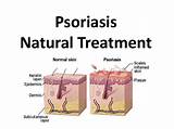 Images of Psoriasis Ayurvedic Treatment Diet