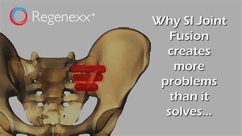 What To Know About Sacroiliac Joint Fusion