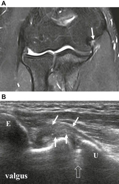 The ulnar collateral ligament (ucl) can become stretched, frayed or torn through the stress of repetitive throwing motions, causing ulnar collateral ligament injuries. Stress ultrasound in baseball players with ulnar ...
