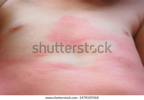 Severe Eczema Skin Rash Allergic Reaction Stock Photo Edit Now 1478109368