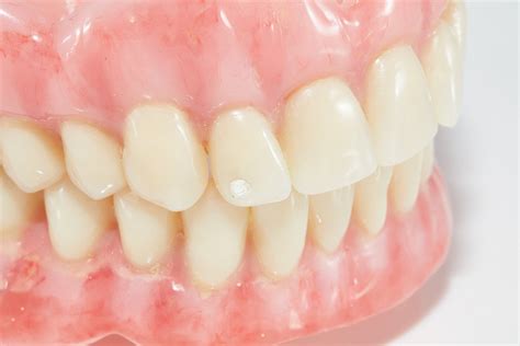 Full And Partial Dentures Tweed Heads Bromleys Denture Clinic