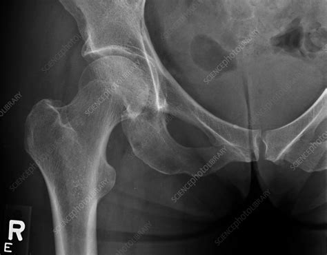 Metastasis In Right Hip X Ray Stock Image C0393373 Science