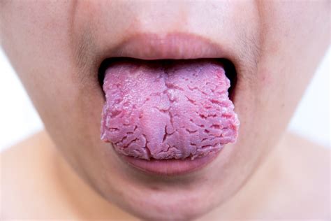 This article is about canker sores their symptoms orajel mouth sore gel provides instant relief from the pain of mouth sores caused by canker sores, cold mouth sores are lesions that can appear on any of the soft tissues of the mouth, including the lips. A grooved tongue, white patches, cold sores: Learn about ...