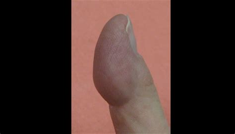 Derm Dx Mass Under The Skin Of The Index Finger Clinical Advisor