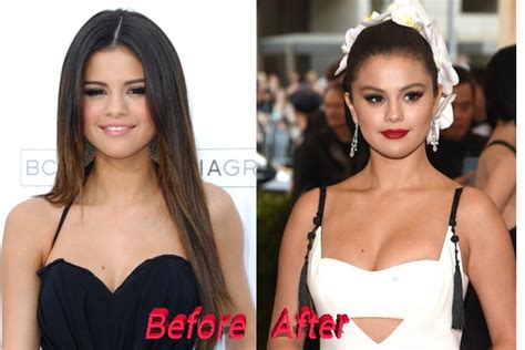 Selena Gomez Nose Job Plastic Surgery Really