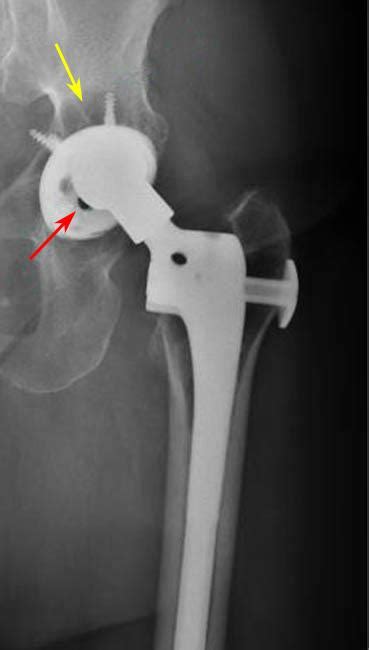Revision Total Hip Replacement Orthoinfo Aaos 2023