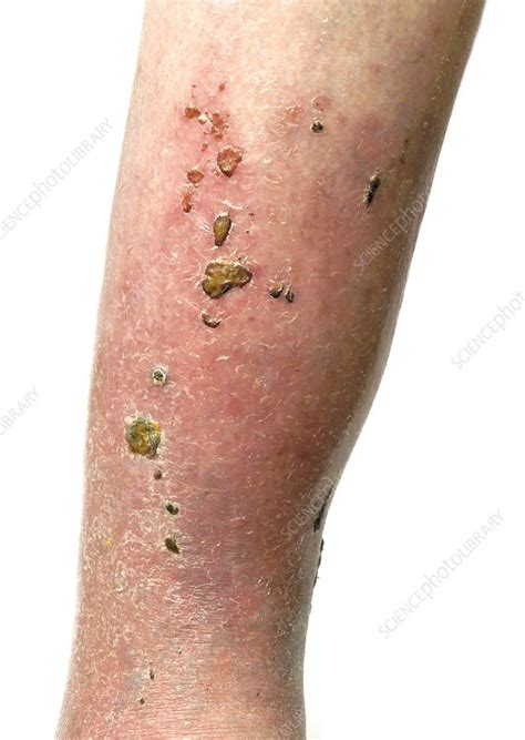 Cellulitis And Infected Scabs Stock Image C0164812 Science Photo