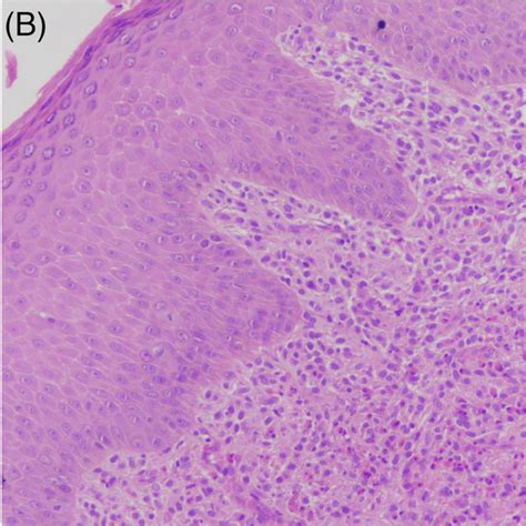 Mastocytoma Over Left Hypochondrium Solitary Well‐defined