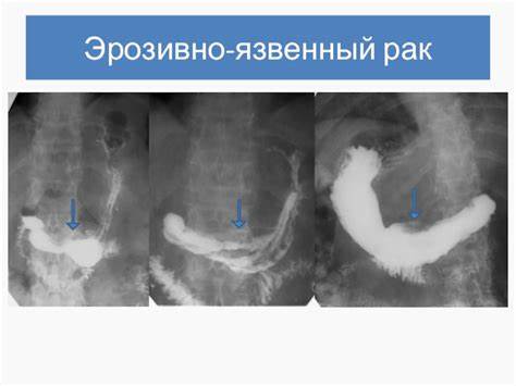 Эрозивно язвенный эзофагит диета