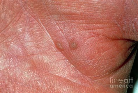 View Of Two Warts On The Palm Of A Hand Photograph By Jane Shemilt