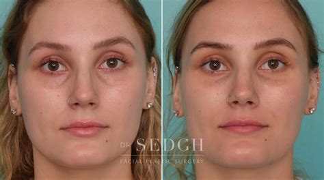 Tear Trough Filler Before And After Photos Dr Jacob Sedgh