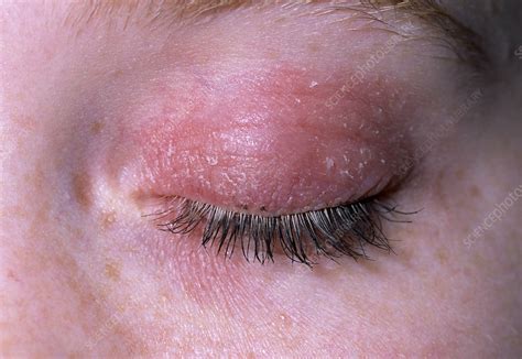 Eczema On Eyelid Stock Image M1500217 Science Photo Library