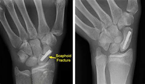 Scaphoid Fracture Causes Symptoms Diagnosis Treatment Revovery Time