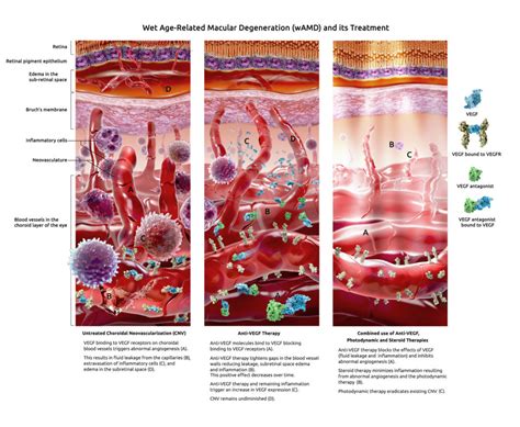 Wet Amd Therapy Geras Healthcare Productions