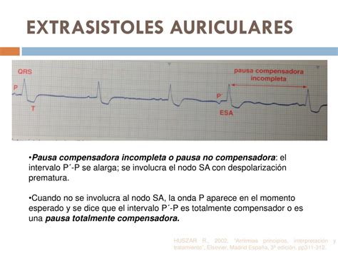 Ppt Extrasístoles Y Síndromes De Preexitación Wpw Y Long Ganong L