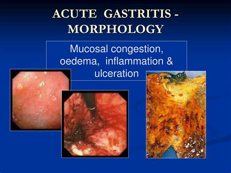 Acute Gastritis