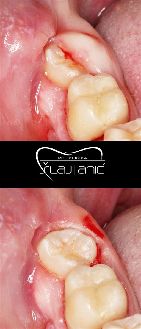 Operkulektomija Laserom Bezbolno Uklanjanje Suvišnog Zubnog Mesa Koje