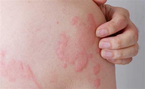 Hives On Right Side Causes Symptoms And Treatments