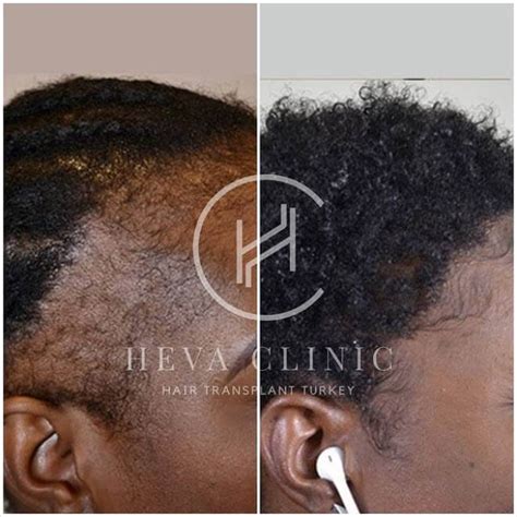 Share Hair Relaxer Before And After Latest Dedaotaonec