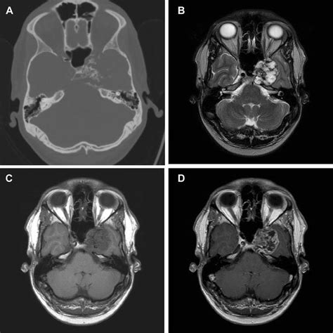 Chondrosarcoma Imaging Of Skull Base Chondrosarcoma Arising From The