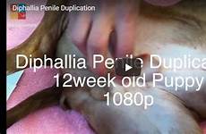 diphallia penile duplication