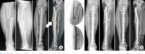 Pdf A Correction Of Malunion Or Deformity In The Lower Extremity