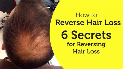 How To Reverse Hair Loss 6 Secrets For Reversing Hair Loss Youtube