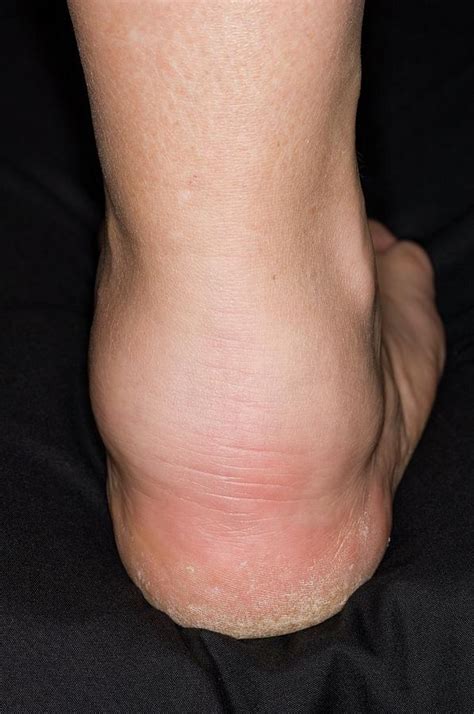 Swollen Ankle From Vasculitis Photograph By Dr P Marazziscience Photo