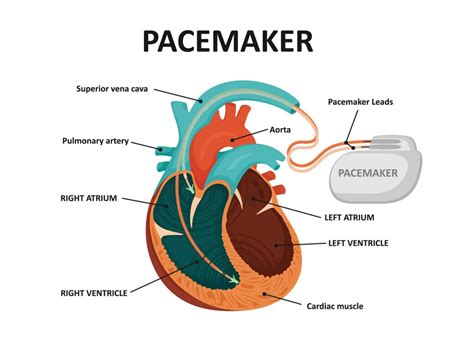 Pacemakers Capital Heart Centre