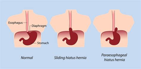 Can A Hiatal Hernia Cause Bloating