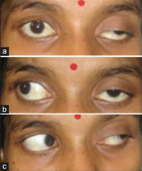 Complete means that there is complete closure of the eyelid and the muscles innervated by the 3rd cranial nerve are severely affected. Complete third nerve palsy: Only presenting sign of ...