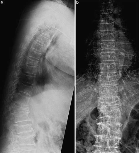 In Osteoporosis Radiology Key