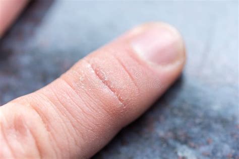 Dry Cracked Skin On The Finger Of A Male Hand Stock Image Image Of